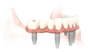 brug op 4 implantaten in onderkaak